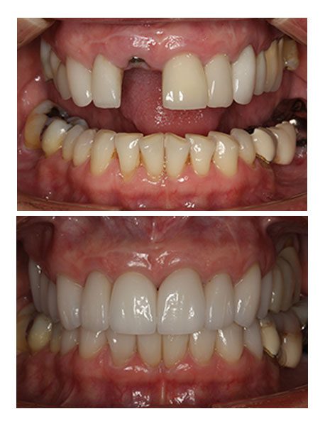 dental implants before after burkhard