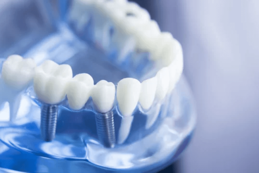 dental implants grosse pointe