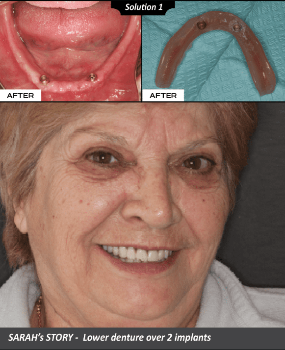 Sarah's before and after denture case