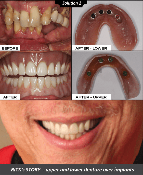 Rick's before and after denture case