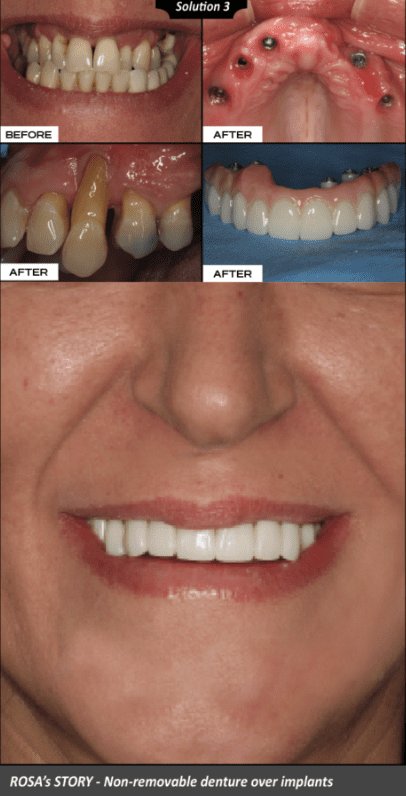 Rosa's before and after denture case