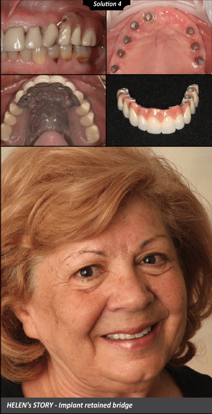 Helen's before and after denture case