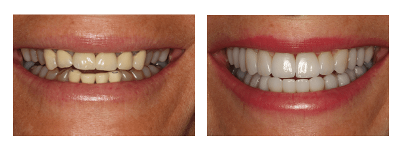 Susan's before and after smile