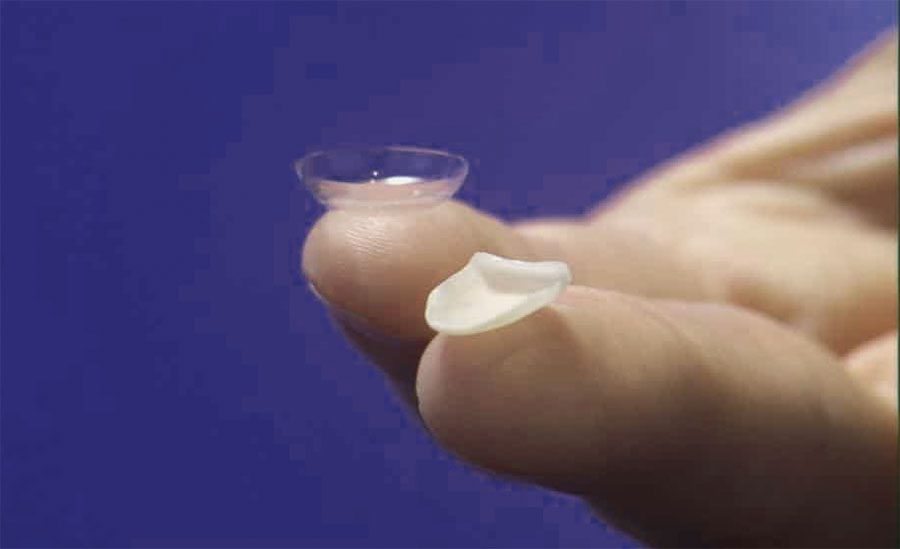 prepless veneer size comparison to a contact lens