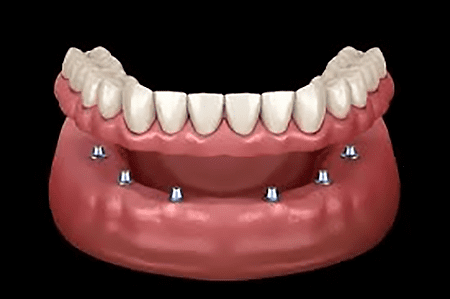dentures supported by dental implants