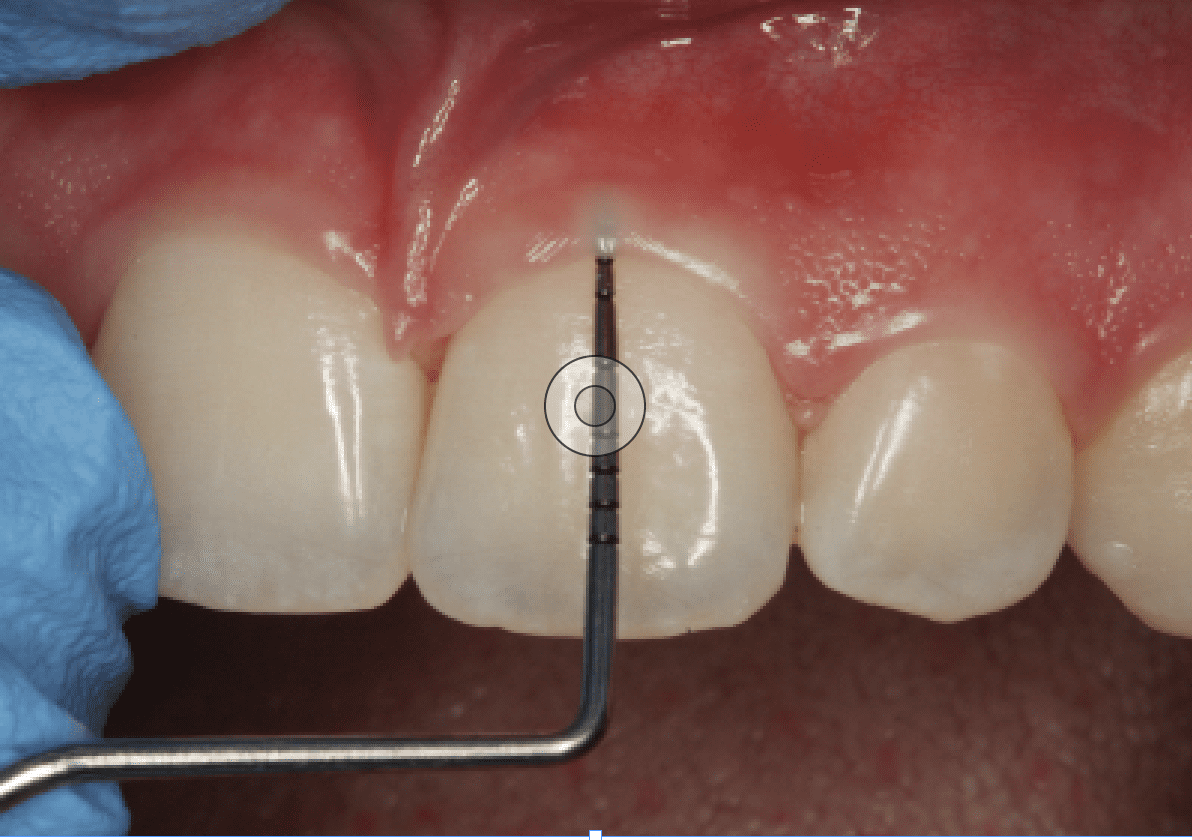 Gum Disease Probe