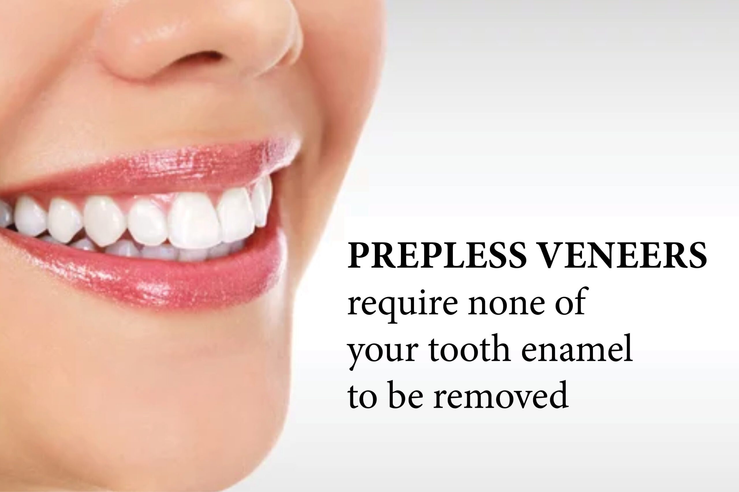 prepless veneers - no tooth removed