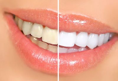 teeth-whitening