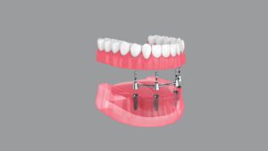 implant-retained dentures